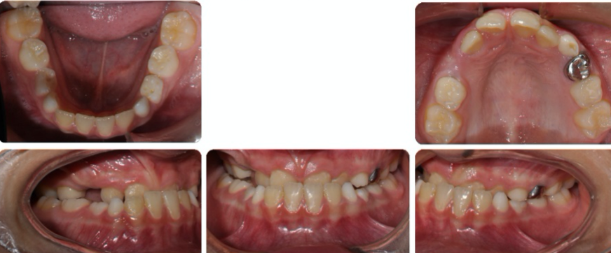 A collage of a child's teethDescription automatically generated