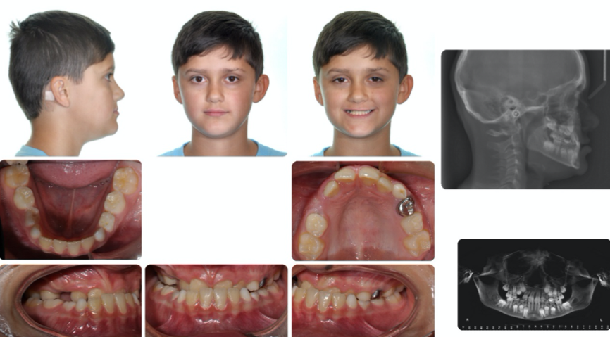 A collage of a child's teethDescription automatically generated