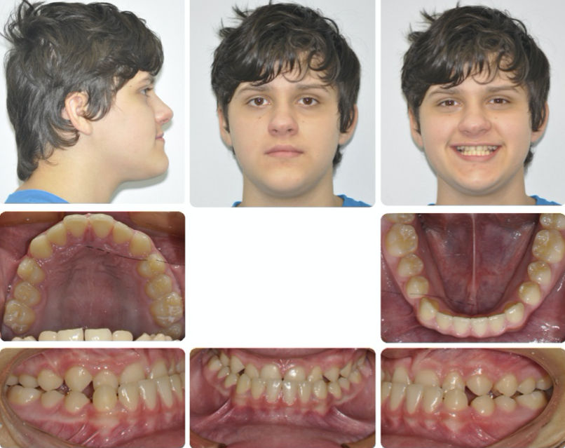 A collage of a child's teethDescription automatically generated