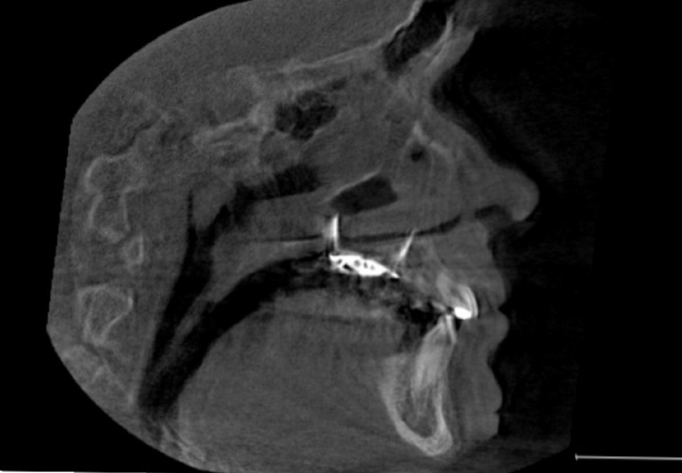 A x-ray of a person's headDescription automatically generated